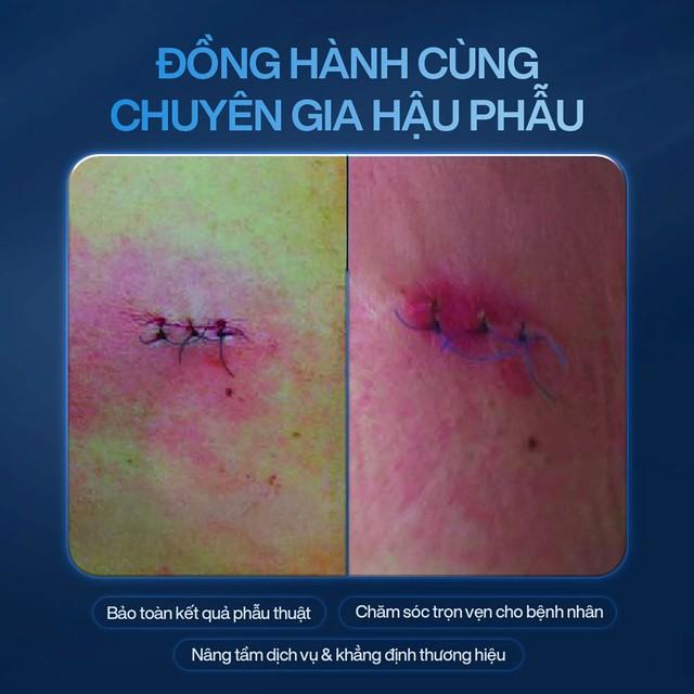 Plasma Lạnh có thật sự giúp diệt khuẩn cho vết thương mau lành, ngừa sẹo hiệu quả?- Ảnh 5.