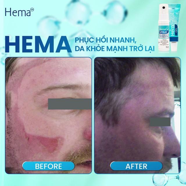 Xịt vết thương mạn tính Hemacut Spay có tốt không? - Ảnh 6.