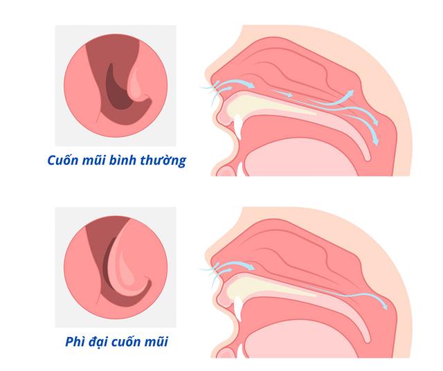 Giải phóng đường thở cho người đàn ông nghẹt mũi 5 năm, lệ thuộc thuốc co mạch- Ảnh 2.