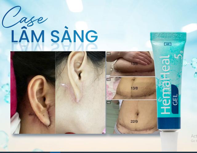 Cách sử dụng xịt vết thương hở Hema chuẩn y khoa, da phục hồi nhanh- Ảnh 8.