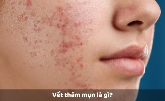 Làm đẹp da láng mịn không thâm mụn Nhờ skincare chuẩn y khoa tại nhà - Ảnh 2.