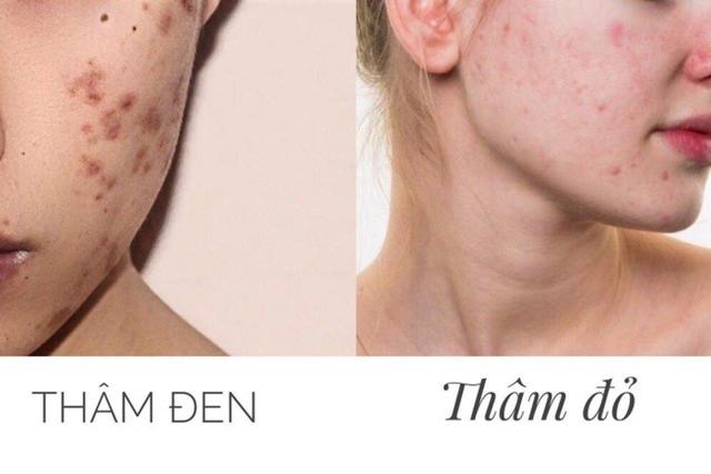 Làm đẹp da láng mịn không thâm mụn Nhờ skincare chuẩn y khoa tại nhà - Ảnh 3.