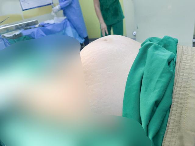 Phẫu thuật cắt tử cung vì khối u xơ khổng lồ nặng hơn 4 kg - Ảnh 1.