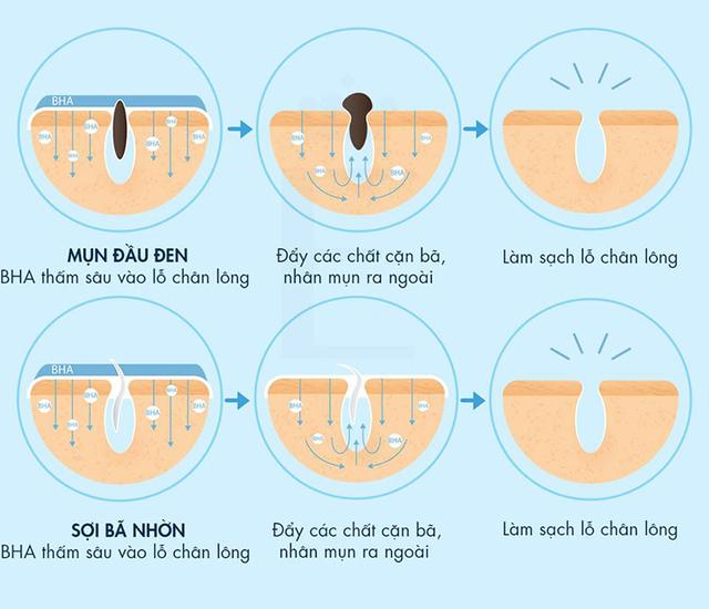Da mụn nên dùng BHA hay AHA - phương pháp chăm da mụn chuẩn khoa học- Ảnh 1.