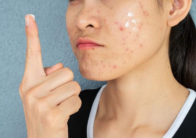 Da vùng má dễ bị thâm mụn? Cách chăm sóc da giúp da đều màu hơn- Ảnh 1.