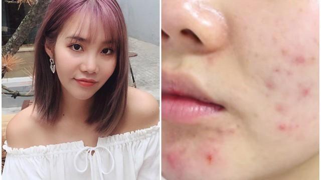 Sát Tết mới cuống skincare: 5 sai lầm khiến da ‘banh’ không kịp phục hồi- Ảnh 2.