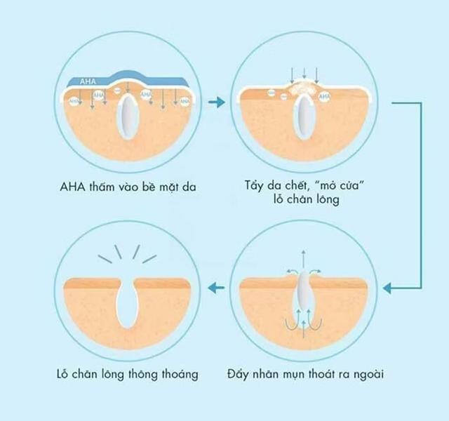 Da mụn nên dùng BHA hay AHA - phương pháp chăm da mụn chuẩn khoa học- Ảnh 2.