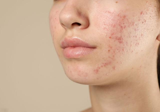 Da vùng má dễ bị thâm mụn? Cách chăm sóc da giúp da đều màu hơn- Ảnh 2.