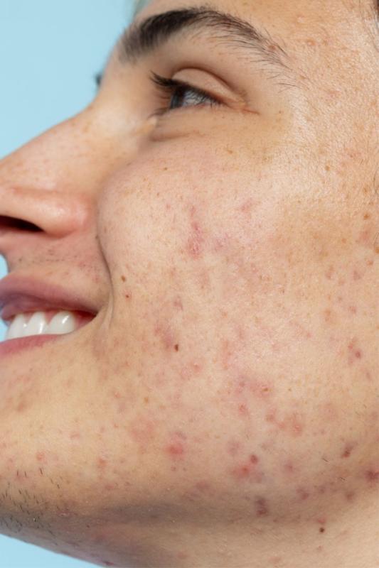 Vì sao da sau mụn dễ thâm và để lại sẹo? - Ảnh 2.