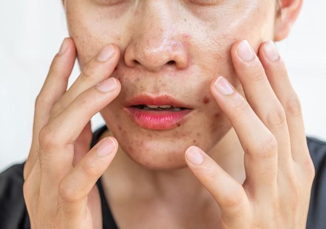 Da vùng má dễ bị thâm mụn? Cách chăm sóc da giúp da đều màu hơn- Ảnh 3.