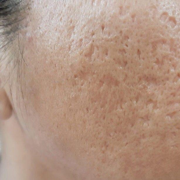 Vì sao da sau mụn dễ thâm và để lại sẹo? - Ảnh 3.