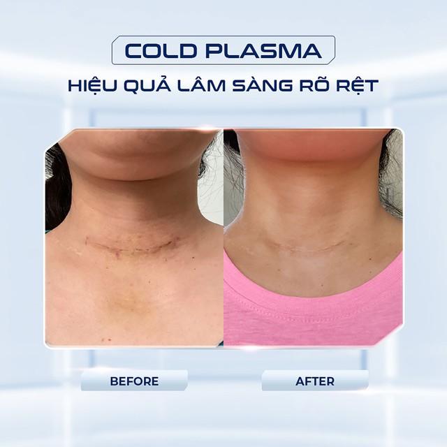 Cold Plasma: Hướng tiếp cận sinh học mới trong chăm sóc da và lành thương hiện đại - Ảnh 4.