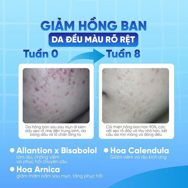 Da vùng má dễ bị thâm mụn? Cách chăm sóc da giúp da đều màu hơn- Ảnh 6.