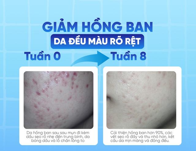 Vì sao da sau mụn dễ thâm và để lại sẹo? - Ảnh 6.