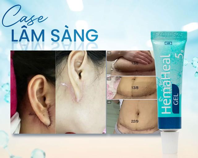 Gel bôi vết thương hở HemaHeal có hỗ trợ mau lành như quảng cáo không? - Ảnh 1.