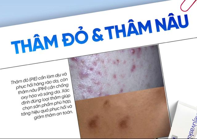 Top cách chăm sóc da thâm đỏ sau mụn bạn nên thử ngay trong routine hằng ngày- Ảnh 1.