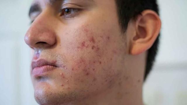 Nam giới bị sẹo rỗ: Khi nào da còn khả năng tăng sinh collagen để cải thiện?- Ảnh 1.