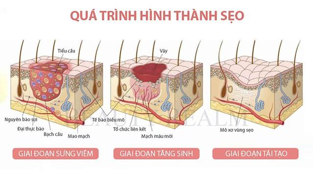 Nam giới bị sẹo rỗ: Khi nào da còn khả năng tăng sinh collagen để cải thiện?- Ảnh 2.