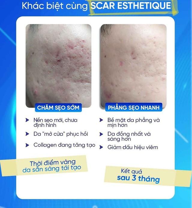 Nam giới bị sẹo rỗ: Khi nào da còn khả năng tăng sinh collagen để cải thiện?- Ảnh 3.