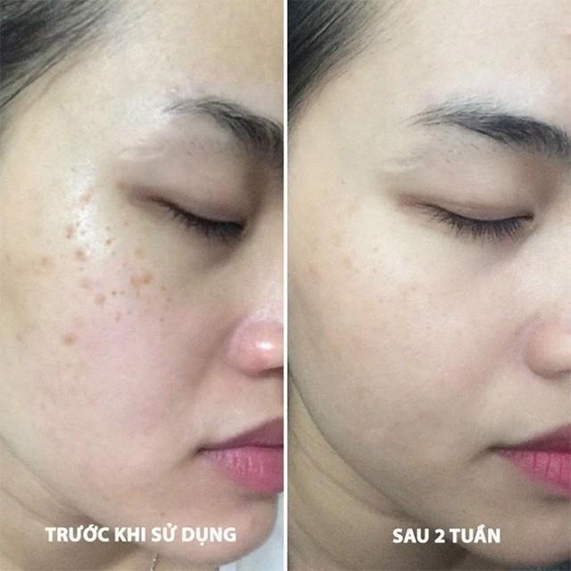 Top 5 serum giúp ‘tạm biệt’ nám, thậm chí nám hỗn hợp tưởng như chưa tồn tại - Ảnh 1.