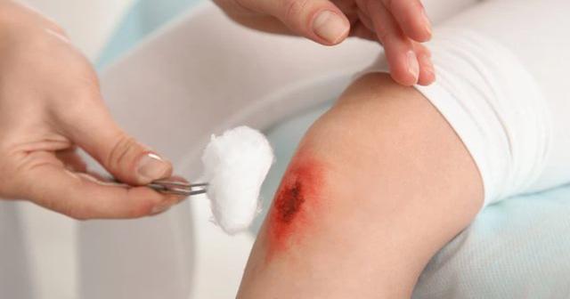 Chuyên gia giải đáp: Vết thương hở nên bôi gì để tránh sẹo xấu? - Ảnh 6.