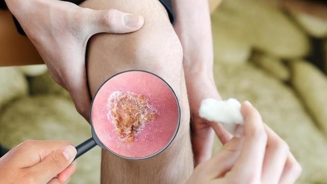 Giải mã ‘cuộc chiến’ vi mô tại vết thương: Khi sự kiểm soát quyết định phục hồi - Ảnh 1.