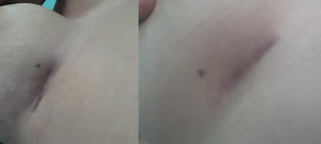 Chuyên gia phẫu thuật thẩm mỹ nói gì về hiệu quả miếng dán ép sẹo sa trễ? - Ảnh 10.