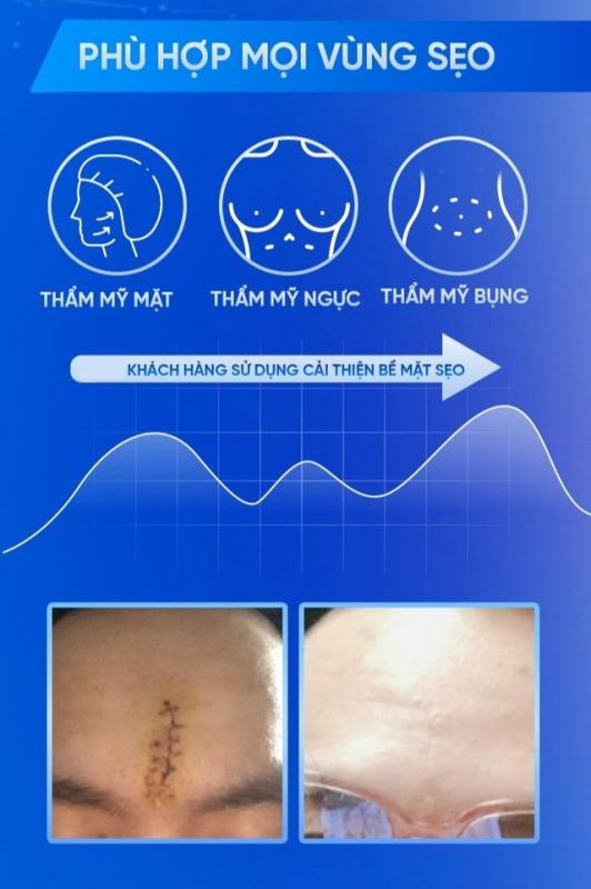 Chuyên gia gợi ý cách dùng kem mờ sẹo lồi hiệu quả sau khoảng 4 tuần- Ảnh 11.