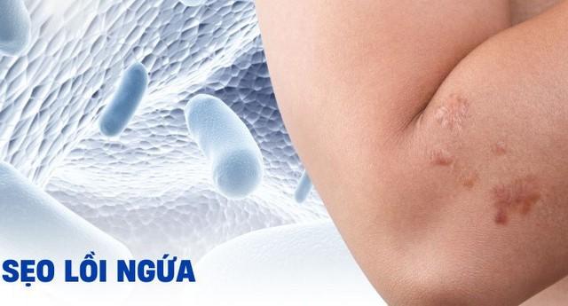 Chuyên gia gợi ý cách dùng kem mờ sẹo lồi hiệu quả sau khoảng 4 tuần- Ảnh 2.