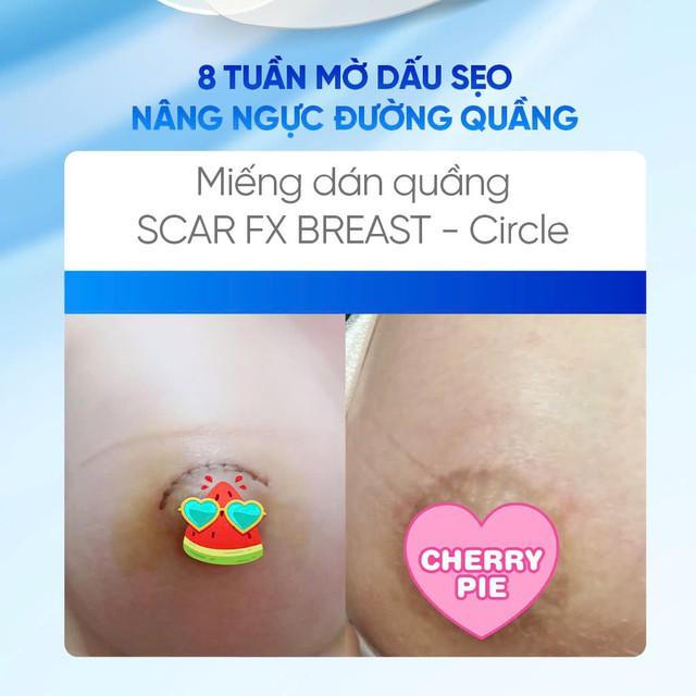 Phẫu thuật treo sa trễ dùng miếng dán silicone nào để da phẳng như chưa dao kéo?- Ảnh 7.