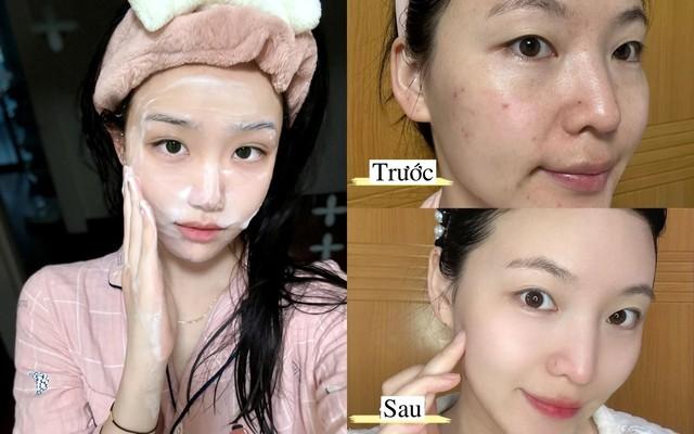 +6 sữa rửa mặt giúp giảm mụn 'cứu nguy' da láng mịn, cải thiện lỗ chân lông - Ảnh 1.