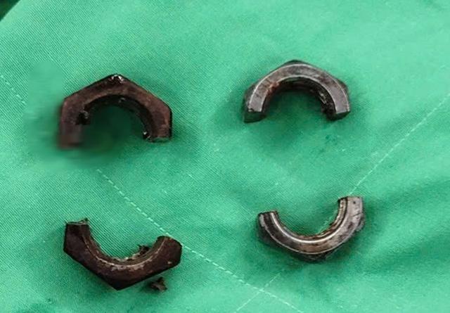 Suýt phải cắt bỏ dương vật bị 2 con ốc kim loại siết chặt - Ảnh 2.
