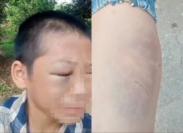 Xác minh vụ bé trai nghi bị mẹ kế và bố đánh đập dã man - Ảnh 2.