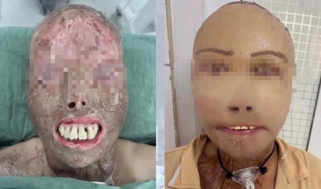 Người đàn ông ngã vào nồi nước sôi và hành trình 16 giờ 'trao trả' gương mặt - Ảnh 1.