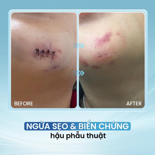 Cách dùng kem bôi vết thương hở tưởng đơn giản nhưng nhiều người vẫn làm sai - Ảnh 12.