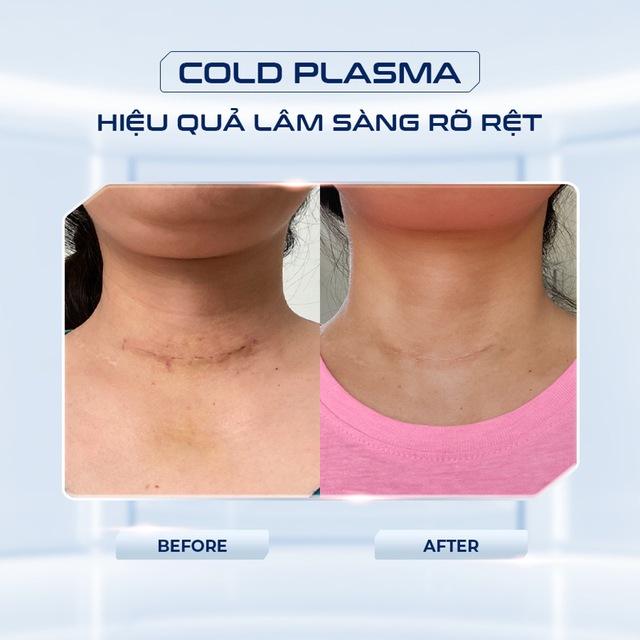 Không còn lo phí vận hành, nhiều spa chọn máy Plasma lạnh không tiêu hao vật tư- Ảnh 6.