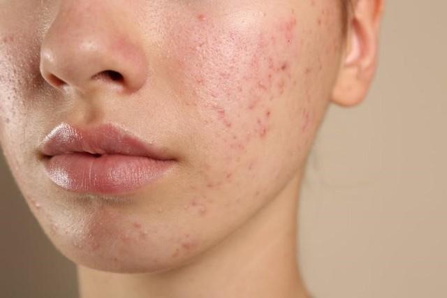 Kháng kháng sinh trong điều trị mụn và giải pháp thay thế từ tia Plasma lạnh- Ảnh 1.