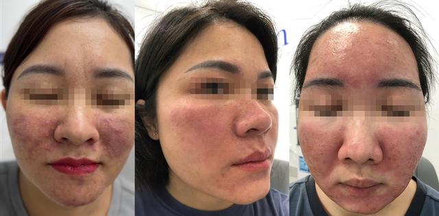 BS.CKII Nguyễn Tiến Thành: Chuyên gia điều trị biến chứng da- Ảnh 1. BS.CKII Nguyễn Tiến Thành: Chuyên gia điều trị biến chứng da- Ảnh 1.