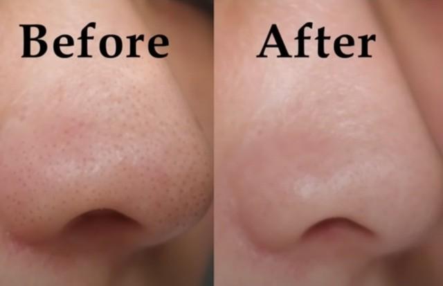 Kem giúp ngừa mụn đầu đen cực đỉnh: Mũi sạch bong, căng bóng như vừa đi spa - Ảnh 12.