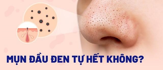 Kem giúp ngừa mụn đầu đen cực đỉnh: Mũi sạch bong, căng bóng như vừa đi spa - Ảnh 2.