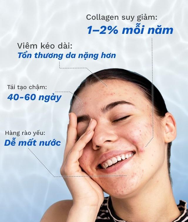 Vì sao skincare rất nhiều nhưng da sau mụn vẫn không đẹp lên? - Ảnh 2.