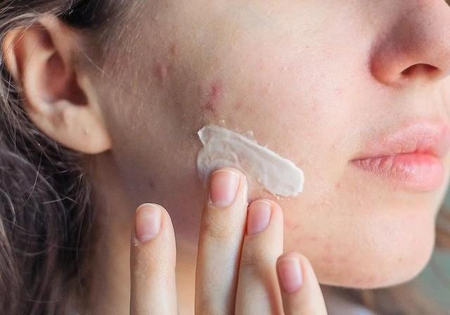 Kháng kháng sinh trong điều trị mụn và giải pháp thay thế từ tia Plasma lạnh- Ảnh 2.