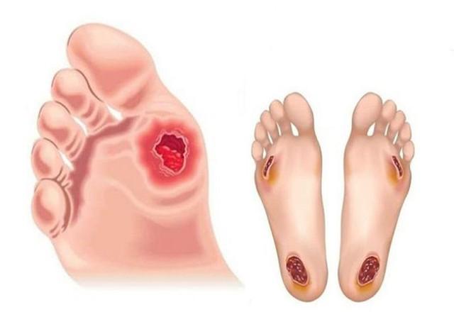 Vết loét lâu lành và nguy cơ hoại tử, dừng ngay việc tự xử lý tại nhà- Ảnh 2.