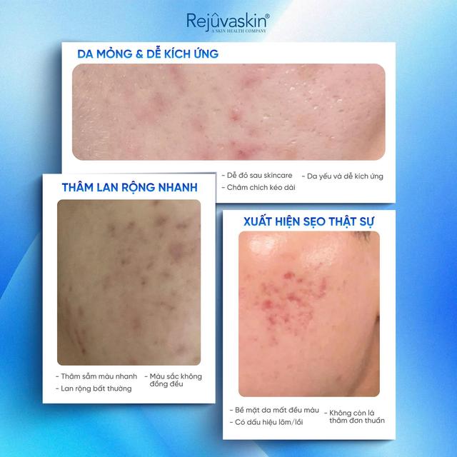 Phục hồi da sau laser: Điều đáng sợ không phải bong da mà là chăm sai cách- Ảnh 2.