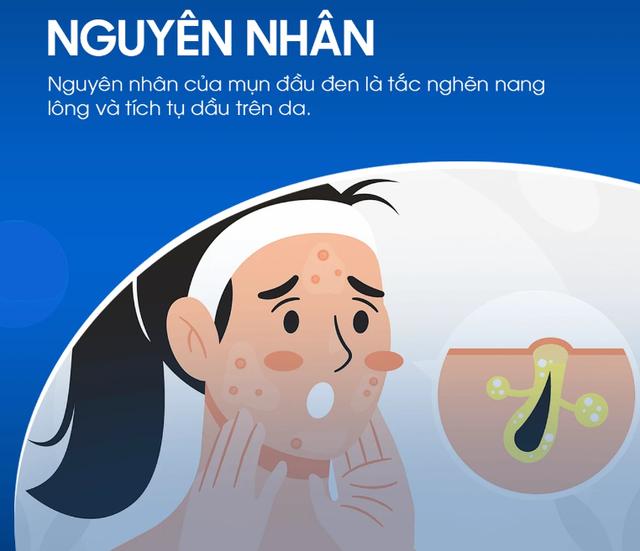 Kem giúp ngừa mụn đầu đen cực đỉnh: Mũi sạch bong, căng bóng như vừa đi spa - Ảnh 3.